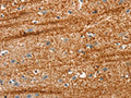 The image on the left is immunohistochemistry of paraffin-embedded Human brain tissue using CSB-PA010692(APC Antibody) at dilution 1/25, on the right is treated with synthetic peptide. (Original magnification: ×200)