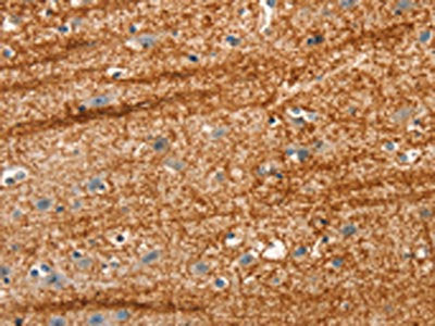 The image on the left is immunohistochemistry of paraffin-embedded Human brain tissue using CSB-PA010692(APC Antibody) at dilution 1/25, on the right is treated with synthetic peptide. (Original magnification: ×200)