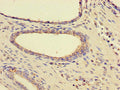 Immunohistochemistry of paraffin-embedded human prostate cancer using CSB-PA010830HA01HU at dilution of 1:100