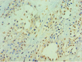 Immunohistochemistry of paraffin-embedded human breast cancer using CSB-PA010950ESR2HU at dilution of 1:100