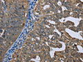 The image on the left is immunohistochemistry of paraffin-embedded Human ovarian cancer tissue using CSB-PA010968(GPAM Antibody) at dilution 1/60, on the right is treated with fusion protein. (Original magnification: ×200)