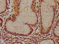 IHC image of CSB-PA011036LA01HU diluted at 1:100 and staining in paraffin-embedded human gastric cancer performed on a Leica BondTM system. After dewaxing and hydration, antigen retrieval was mediated by high pressure in a citrate buffer (pH 6.0). Section was blocked with 10% normal goat serum 30min at RT. Then primary antibody (1% BSA) was incubated at 4°C overnight. The primary is detected by a biotinylated secondary antibody and visualized using an HRP conjugated SP system.