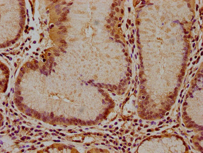 IHC image of CSB-PA011036LA01HU diluted at 1:100 and staining in paraffin-embedded human gastric cancer performed on a Leica BondTM system. After dewaxing and hydration, antigen retrieval was mediated by high pressure in a citrate buffer (pH 6.0). Section was blocked with 10% normal goat serum 30min at RT. Then primary antibody (1% BSA) was incubated at 4°C overnight. The primary is detected by a biotinylated secondary antibody and visualized using an HRP conjugated SP system.