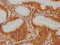 IHC image of CSB-PA011041NA01HU diluted at 1:100 and staining in paraffin-embedded human gastric cancer performed on a Leica BondTM system. After dewaxing and hydration, antigen retrieval was mediated by high pressure in a citrate buffer (pH 6.0). Section was blocked with 10% normal goat serum 30min at RT. Then primary antibody (1% BSA) was incubated at 4°C overnight. The primary is detected by a biotinylated secondary antibody and visualized using an HRP conjugated SP system.