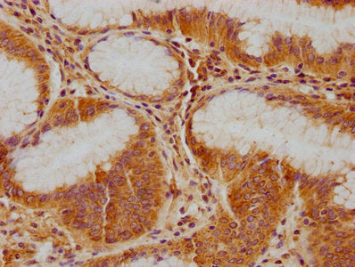 IHC image of CSB-PA011041NA01HU diluted at 1:100 and staining in paraffin-embedded human gastric cancer performed on a Leica BondTM system. After dewaxing and hydration, antigen retrieval was mediated by high pressure in a citrate buffer (pH 6.0). Section was blocked with 10% normal goat serum 30min at RT. Then primary antibody (1% BSA) was incubated at 4°C overnight. The primary is detected by a biotinylated secondary antibody and visualized using an HRP conjugated SP system.