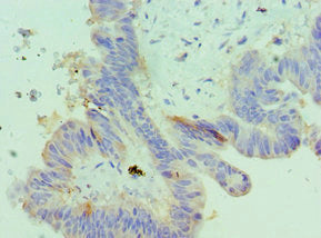 Immunohistochemistry of paraffin-embedded human colon cancer using CSB-PA011098ESR2HU at dilution of 1:100