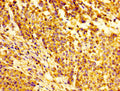 Immunohistochemistry of paraffin-embedded human colon cancer using CSB-PA011100LA01HU at dilution of 1:100