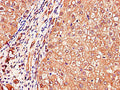 Immunohistochemistry of paraffin-embedded human liver cancer using CSB-PA011172LA01HU at dilution of 1:100