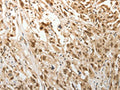 The image on the left is immunohistochemistry of paraffin-embedded Human esophagus cancer tissue using CSB-PA011355(ADIPOR2 Antibody) at dilution 1/15, on the right is treated with synthetic peptide. (Original magnification: ×200)
