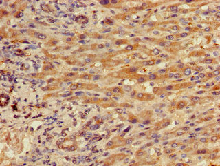 Immunohistochemistry of paraffin-embedded human liver cancer using CSB-PA011889LA01HU at dilution of 1:100