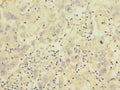 Immunohistochemistry of paraffin-embedded human liver cancer using CSB-PA011891ESR2HU at dilution of 1:100