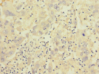 Immunohistochemistry of paraffin-embedded human liver cancer using CSB-PA011891ESR2HU at dilution of 1:100