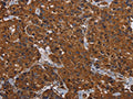 The image on the left is immunohistochemistry of paraffin-embedded Human breast cancer tissue using CSB-PA011966(HYAL2 Antibody) at dilution 1/60, on the right is treated with fusion protein. (Original magnification: ×200)