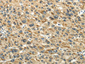 The image on the left is immunohistochemistry of paraffin-embedded Human liver cancer tissue using CSB-PA011976(KEAP1 Antibody) at dilution 1/20, on the right is treated with fusion protein. (Original magnification: ×200)