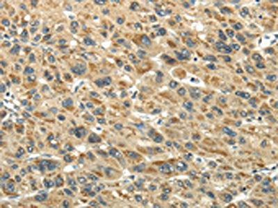 The image on the left is immunohistochemistry of paraffin-embedded Human liver cancer tissue using CSB-PA011976(KEAP1 Antibody) at dilution 1/20, on the right is treated with fusion protein. (Original magnification: ×200)