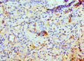 Immunohistochemistry of paraffin-embedded human lung cancer using CSB-PA012203ESR1HU at dilution of 1:100