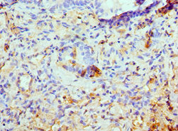 Immunohistochemistry of paraffin-embedded human lung cancer using CSB-PA012203ESR1HU at dilution of 1:100