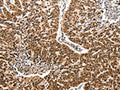 The image on the left is immunohistochemistry of paraffin-embedded Human lung cancer tissue using CSB-PA012674(CCL2 Antibody) at dilution 1/50, on the right is treated with synthetic peptide. (Original magnification: ×200)