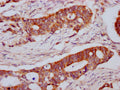 IHC image of CSB-PA013065LA01HU diluted at 1:800 and staining in paraffin-embedded human colon cancer performed on a Leica BondTM system. After dewaxing and hydration, antigen retrieval was mediated by high pressure in a citrate buffer (pH 6.0). Section was blocked with 10% normal goat serum 30min at RT. Then primary antibody (1% BSA) was incubated at 4&deg;C overnight. The primary is detected by a biotinylated secondary antibody and visualized using an HRP conjugated SP system.