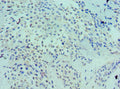 Immunohistochemistry of paraffin-embedded human breast cancer using CSB-PA013102ESR2HU at dilution of 1:100