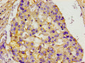 Immunohistochemistry of paraffin-embedded human breast cancer using CSB-PA013592LA01HU at dilution of 1:100