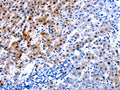The image on the left is immunohistochemistry of paraffin-embedded Human liver cancer tissue using CSB-PA013952(IL2RA Antibody) at dilution 1/30, on the right is treated with synthetic peptide. (Original magnification: ×200)