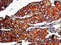The image is immunohistochemistry of paraffin-embedded Human breast cancer tissue using CSB-PA014205(MMP3 Antibody) at dilution 1/10. (Original magnification: ×200)
