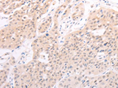 The image on the left is immunohistochemistry of paraffin-embedded Human lung cancer tissue using CSB-PA014237(F7 Antibody) at dilution 1/40, on the right is treated with fusion protein. (Original magnification: ×200)
