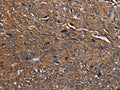 The image on the left is immunohistochemistry of paraffin-embedded Human renal cancer tissue using CSB-PA014449(HYAL2 Antibody) at dilution 1/40, on the right is treated with fusion protein. (Original magnification: ×200)