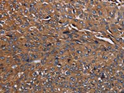 The image on the left is immunohistochemistry of paraffin-embedded Human renal cancer tissue using CSB-PA014449(HYAL2 Antibody) at dilution 1/40, on the right is treated with fusion protein. (Original magnification: ×200)