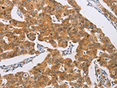 The image on the left is immunohistochemistry of paraffin-embedded Human breast cancer tissue using CSB-PA014480(AGAP2 Antibody) at dilution 1/30, on the right is treated with synthetic peptide. (Original magnification: ×200)