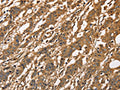The image on the left is immunohistochemistry of paraffin-embedded Human gastic cancer tissue using CSB-PA014561(CAPZA3 Antibody) at dilution 1/40, on the right is treated with fusion protein. (Original magnification: ×200)