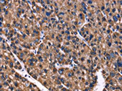The image on the left is immunohistochemistry of paraffin-embedded Human liver cancer tissue using CSB-PA014587(PHB Antibody) at dilution 1/40, on the right is treated with fusion protein. (Original magnification: ×200)