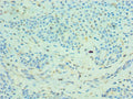 Immunohistochemistry of paraffin-embedded human breast cancer using CSB-PA014661ESR1HU at dilution of 1:100