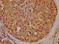 IHC image of CSB-PA014666LA01HU diluted at 1:200 and staining in paraffin-embedded human breast cancer performed on a Leica BondTM system. After dewaxing and hydration, antigen retrieval was mediated by high pressure in a citrate buffer (pH 6.0). Section was blocked with 10% normal goat serum 30min at RT. Then primary antibody (1% BSA) was incubated at 4°C overnight. The primary is detected by a biotinylated secondary antibody and visualized using an HRP conjugated SP system.