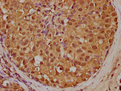 IHC image of CSB-PA014666LA01HU diluted at 1:200 and staining in paraffin-embedded human breast cancer performed on a Leica BondTM system. After dewaxing and hydration, antigen retrieval was mediated by high pressure in a citrate buffer (pH 6.0). Section was blocked with 10% normal goat serum 30min at RT. Then primary antibody (1% BSA) was incubated at 4°C overnight. The primary is detected by a biotinylated secondary antibody and visualized using an HRP conjugated SP system.