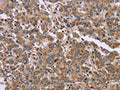 The image on the left is immunohistochemistry of paraffin-embedded Human liver cancer tissue using CSB-PA015538(FAM3B Antibody) at dilution 1/30, on the right is treated with fusion protein. (Original magnification: ×200)