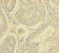 Immunohistochemistry of paraffin-embedded human endometrial cancer using CSB-PA015631EA01HU at dilution of 1:100