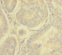 Immunohistochemistry of paraffin-embedded human endometrial cancer using CSB-PA015631EA01HU at dilution of 1:100