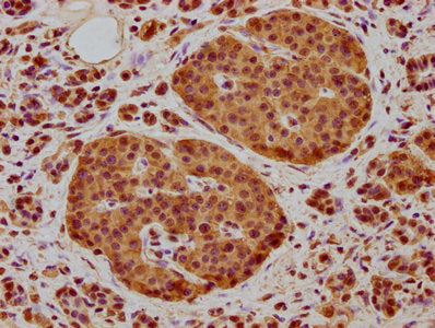 IHC image of CSB-PA015722LA01HU diluted at 1:400 and staining in paraffin-embedded human pancreatic cancer performed on a Leica BondTM system. After dewaxing and hydration, antigen retrieval was mediated by high pressure in a citrate buffer (pH 6.0). Section was blocked with 10% normal goat serum 30min at RT. Then primary antibody (1% BSA) was incubated at 4°C overnight. The primary is detected by a biotinylated secondary antibody and visualized using an HRP conjugated SP system.