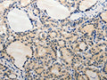 The image on the left is immunohistochemistry of paraffin-embedded Human thyroid cancer tissue using CSB-PA015833(ADAMTS6 Antibody) at dilution 1/20, on the right is treated with synthetic peptide. (Original magnification: ×200)