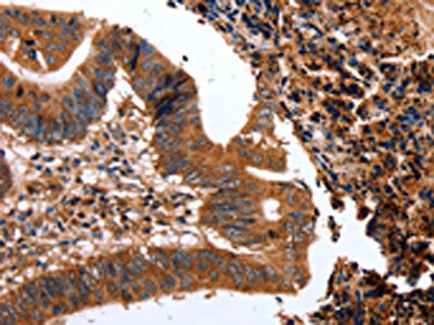 The image on the left is immunohistochemistry of paraffin-embedded Human colon cancer tissue using CSB-PA016840(CLEC4A Antibody) at dilution 1/15, on the right is treated with fusion protein. (Original magnification: ×200)
