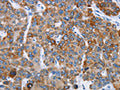 The image on the left is immunohistochemistry of paraffin-embedded Human liver cancer tissue using CSB-PA017354(CHDH Antibody) at dilution 1/20, on the right is treated with fusion protein. (Original magnification: ×200)