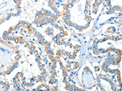 The image on the left is immunohistochemistry of paraffin-embedded Human thyroid cancer tissue using CSB-PA017442(ADRA1A Antibody) at dilution 1/40, on the right is treated with synthetic peptide. (Original magnification: ×200)