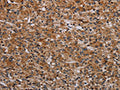 The image on the left is immunohistochemistry of paraffin-embedded Human prostate cancer tissue using CSB-PA018470(RPS6KB2 Antibody) at dilution 1/40, on the right is treated with synthetic peptide. (Original magnification: ×200)