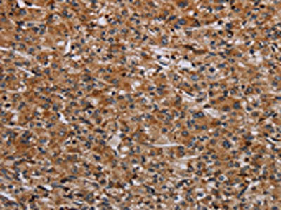 The image on the left is immunohistochemistry of paraffin-embedded Human prostate cancer tissue using CSB-PA018470(RPS6KB2 Antibody) at dilution 1/40, on the right is treated with synthetic peptide. (Original magnification: ×200)