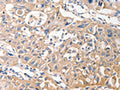 The image on the left is immunohistochemistry of paraffin-embedded Human lung cancer tissue using CSB-PA018595(MVP Antibody) at dilution 1/40, on the right is treated with fusion protein. (Original magnification: ×200)