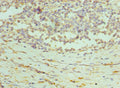 Immunohistochemistry of paraffin-embedded human colon cancer using CSB-PA018653ESR1HU at dilution of 1:100