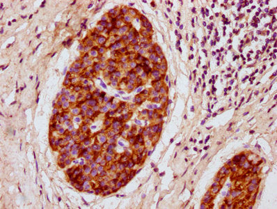 IHC image of CSB-PA018724LA01RA diluted at 1:300 and staining in paraffin-embedded human pancreatic cancer performed on a Leica BondTM system. After dewaxing and hydration, antigen retrieval was mediated by high pressure in a citrate buffer (pH 6.0). Section was blocked with 10% normal goat serum 30min at RT. Then primary antibody (1% BSA) was incubated at 4°C overnight. The primary is detected by a biotinylated secondary antibody and visualized using an HRP conjugated SP system.