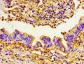 Immunohistochemistry of paraffin-embedded human lung cancer using CSB-PA018830LA01HU at dilution of 1:100